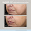 Before and after comparison of a person's face with NuFACE FIX line smoothing serum showing reduced nasal labial folds.